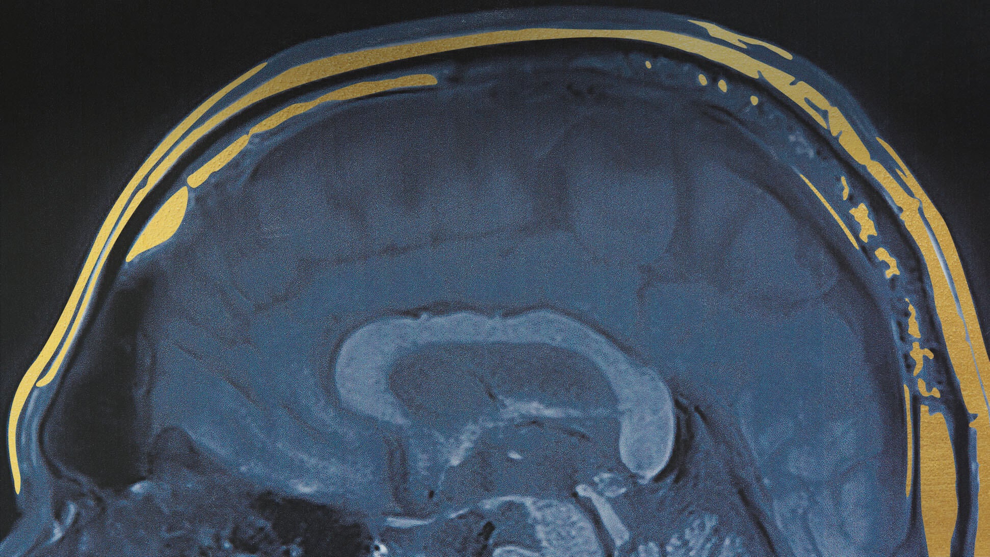 Depth electrode brain MRI
